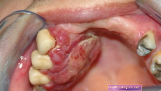 Rak na ustih: kaj je to, simptomi, vzroki in zdravljenje