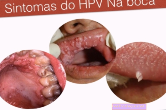 구강 내 HPV : 증상, 치료 및 전염 방법
