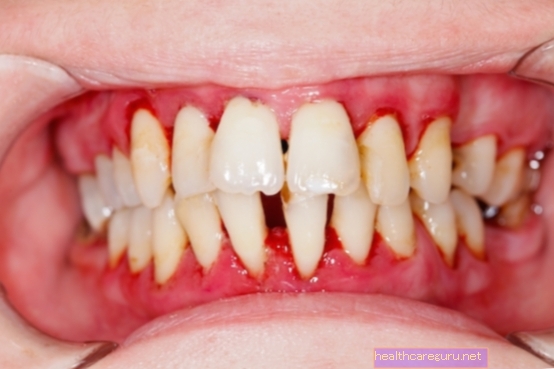 Hvad er periodontitis, symptomer og behandling