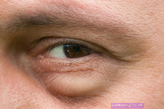 Alergija akims: pagrindinės priežastys, simptomai ir ką daryti