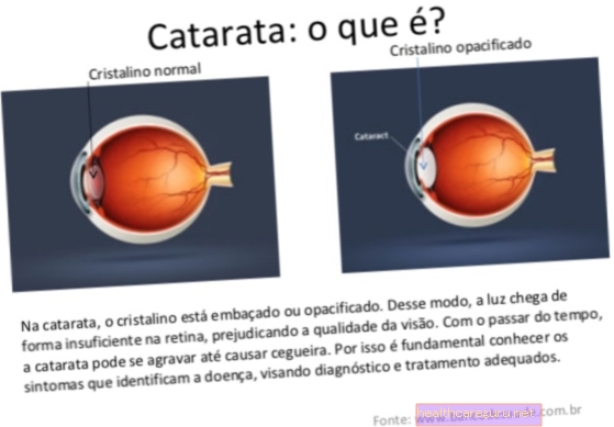Cataracta: ce este, simptome, cauze și tratament