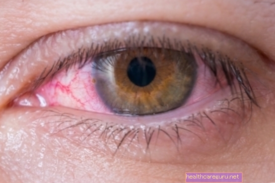 Cara merawat konjungtivitis: salap, titisan mata dan rawatan yang diperlukan