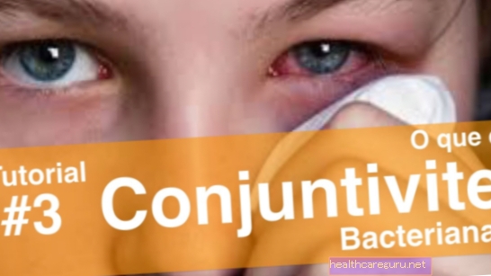 Бактериален конюнктивит: какво представлява, колко дълго продължава и лечение