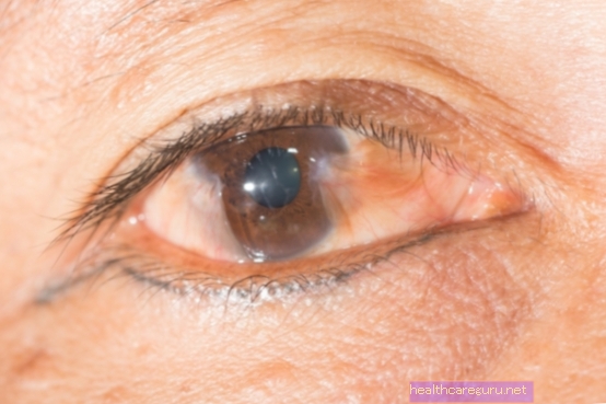 Gul flekk på øyet: 3 hovedårsaker og hva du skal gjøre