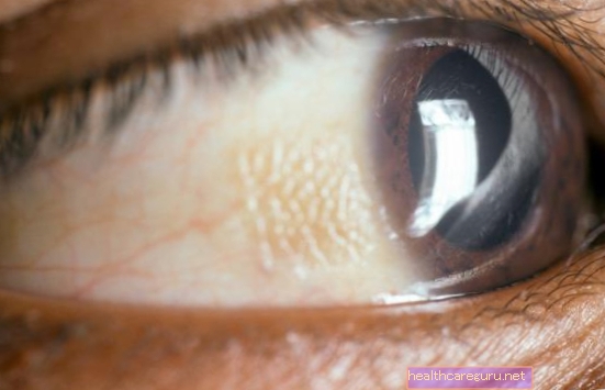 يمكن أن تشير البقعة البيضاء في العين ، والتي تسمى أيضًا الليوكوكوريا ، إلى أمراض خطيرة مثل الورم الأرومي الشبكي أو الساد الخلقي ، على سبيل المثال. تعرف على الأسباب الرئيسية للبقعة البيضاء في العين ومتى تذهب إلى الطبيب