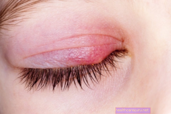 Kas yra blefaritas (patinęs akies vokas) ir kaip gydyti