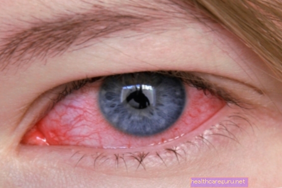 Mata merah: 9 penyebab umum dan apa yang harus dilakukan