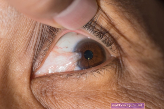 Pterygium silmässä: mikä se on, tärkeimmät oireet ja hoito