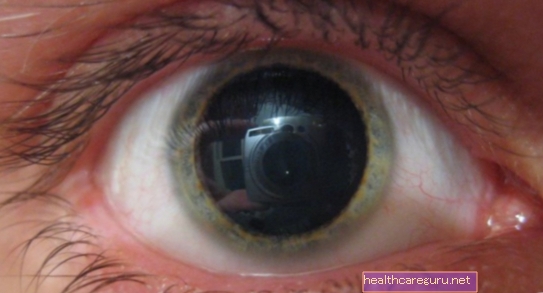 瞳孔の拡張：7つの主な原因とそれが深刻な場合