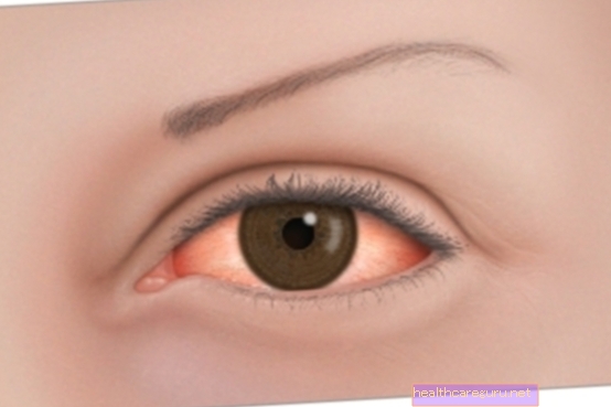 Očna rozaceja: što je to, simptomi i liječenje