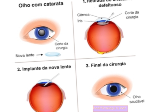 علاج الساد: جراحة أو قطرة للعين