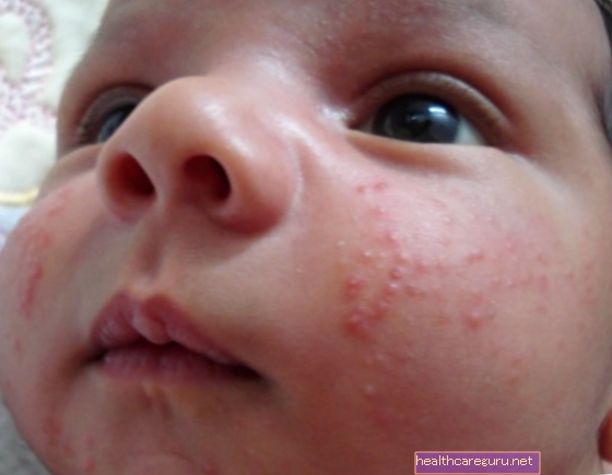 Neonatal akne: vad det är och hur man behandlar finnar hos barnet