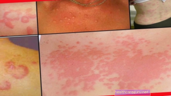 Alergia na detskú pokožku: hlavné príčiny, príznaky a čo robiť