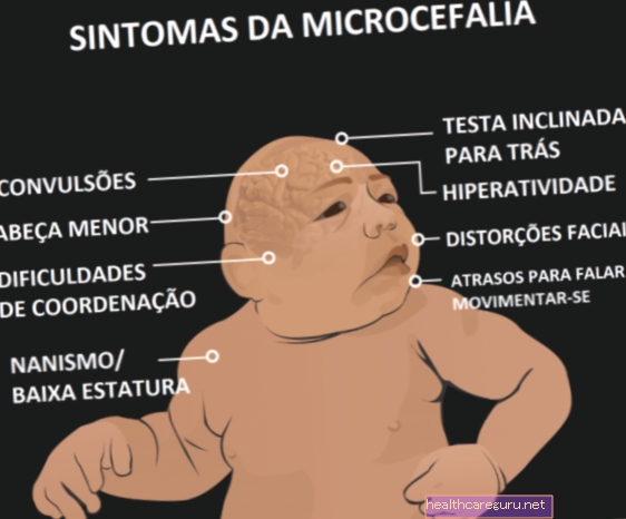 Mikrocefalija: kas tai yra, simptomai, priežastys ir gydymas