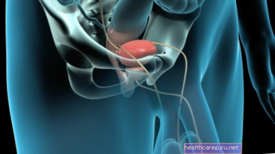 Prostatakirurgi (prostatektomi): hva det er, typer og gjenoppretting