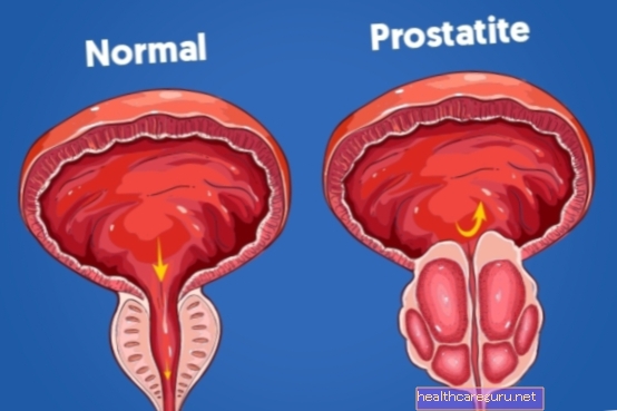 प्रोस्टेटाइटिस, लक्षण और उपचार क्या है