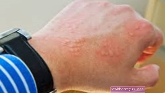 14 ασθένειες που προκαλούν ερυθρές κηλίδες στο δέρμα