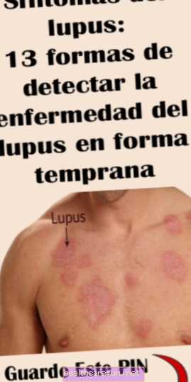 6 huvudsymptom på lupus