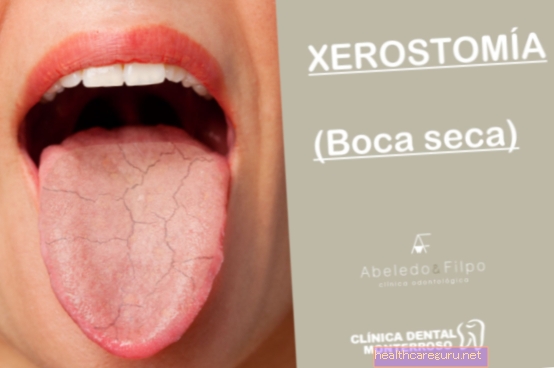 Suha usta (kserostomija): 7 vzrokov in kaj storiti