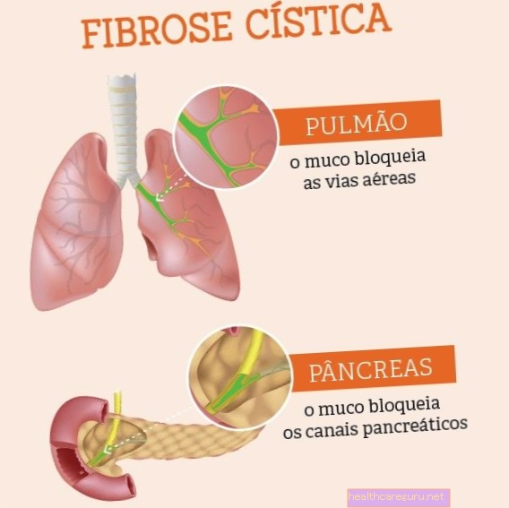 Цистична фиброза: шта је то, главни симптоми, узроци и лечење