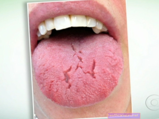 Gezwollen tong: wat het kan zijn en wat te doen