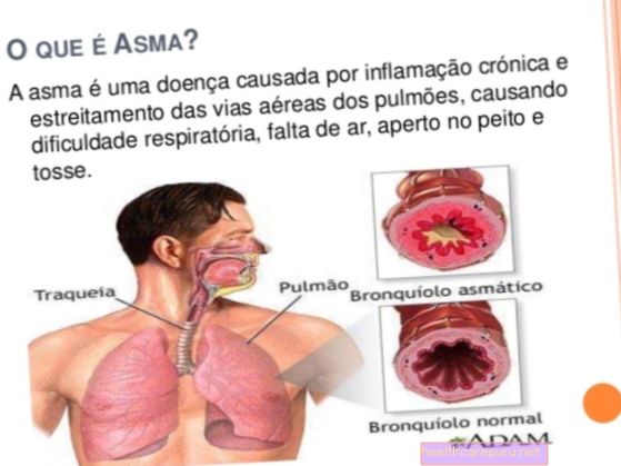 Kas ir astma, simptomi un ārstēšana