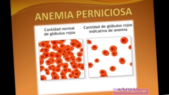 Symptomer på pernisiøs anemi