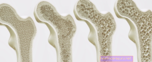 Osteoporoosi sümptomid, diagnoosimine ja kes on kõige suuremas ohus