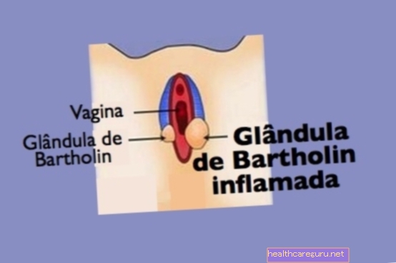 Bartholinová cysta: príčiny, príznaky a liečba
