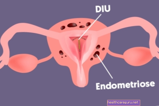 IUD og endometriose: 6 vanligste spørsmål